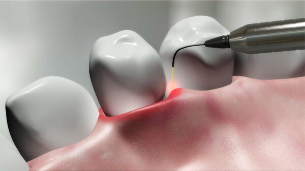 Painless Dentistry